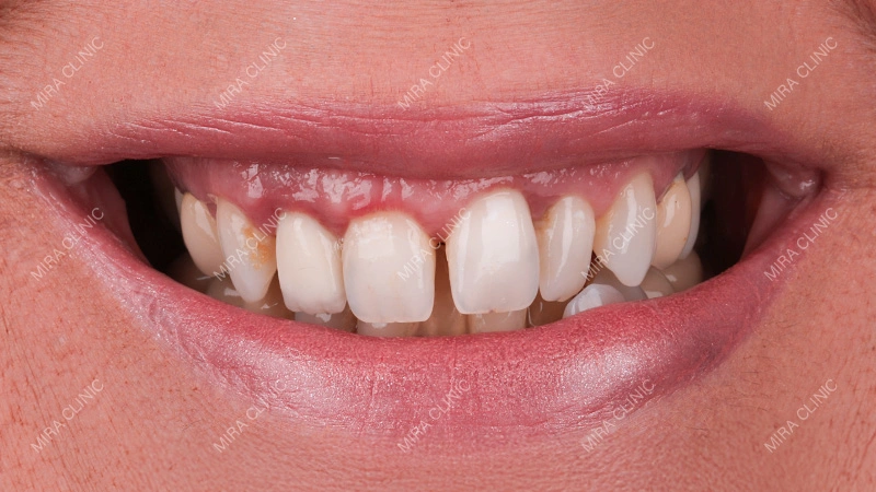 Dental Alignment Treatment